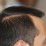 Przeszczep włosów metodą FUE – czym jest, dla kogo i gdzie go wykonać?